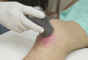 Las úlceras por presión cicatrizan un 33% más rápido con ultrasonidos